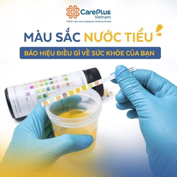 Hinh anh minh hoa sac do mau vang cua nuoc tieu binh thuong tu vang nhat den vang ho phach